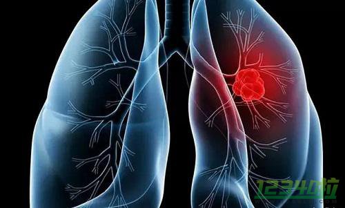 肺癌有几种类型，鳞状上皮细胞癌最常见