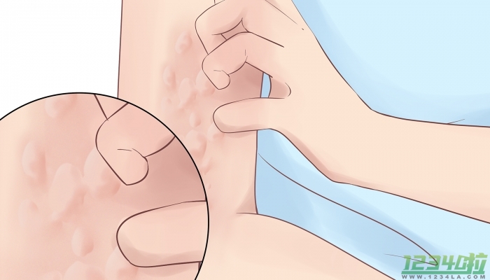 湿疹是由什么引起的 湿疹饮食上注意些什么